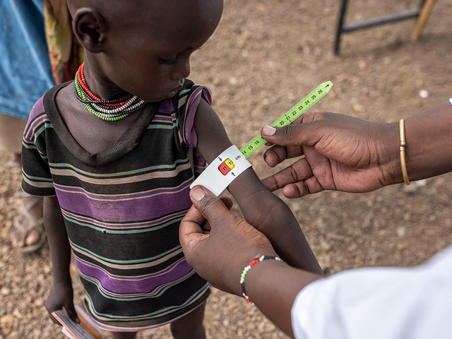 Tvååriga Kaliba testas för undernäring på en av RESCUE:s kliniker.